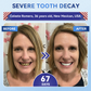 🦷 Tideglusib Sneloplossende Tand- & Tandvleesherstel Orale Strips ✨